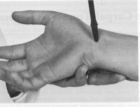 Corticosteroids injection in wrist